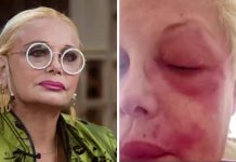 “Puedo perder un ojo”, el grave momento de salud que atraviesa Carmen Barbieri