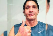 Estevanez se recupera luego de quemarse con alcohol al intentar prender fuego