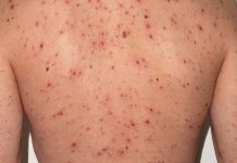 Alerta por un caso de sarampión en Orán tras un viaje a Bs. As. el 14 de noviembre