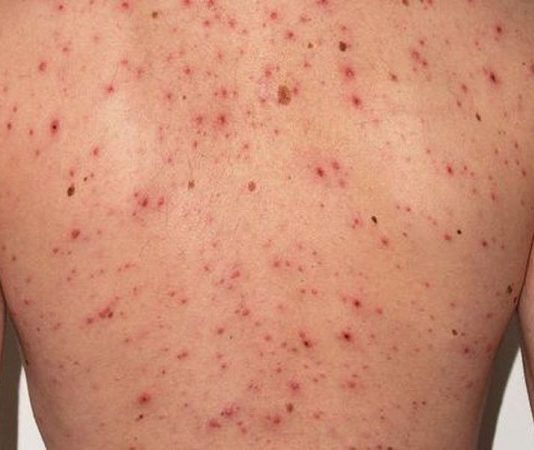 Alerta por un caso de sarampión en Orán tras un viaje a Bs. As. el 14 de noviembre