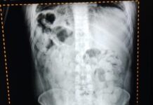 Detienen en Tucuman a dos bolivianos que habían ingerido 180 capsulas de cocaína