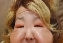 Una influencer brasileña inicia un tratamiento de recuperación tras un procedimiento estético clandestino