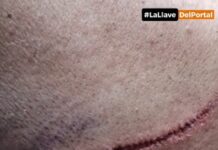 Otro vecino atacado por 4 perros en Campo Quijano