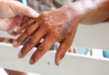 Detectan dos casos de lepra en Orán