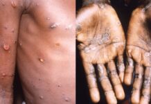 Detectan en la Argentina el primer caso de la viruela del mono más agresiva: cómo prevenirla