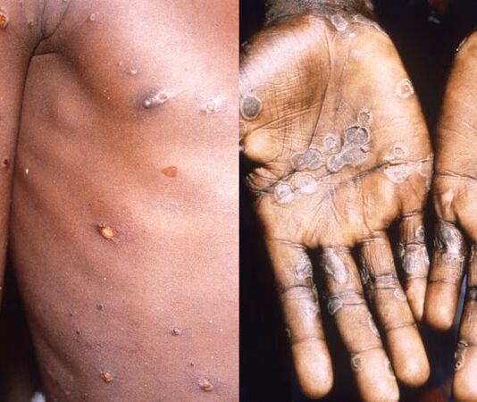 Detectan en la Argentina el primer caso de la viruela del mono más agresiva: cómo prevenirla