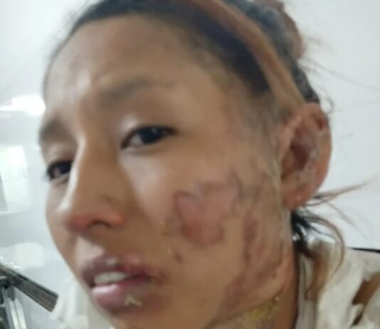 Pidió auxilio tras ser quemada por su pareja, la fiscalía soltó al agresor, hoy la mujer lleva 5 días desaparecida